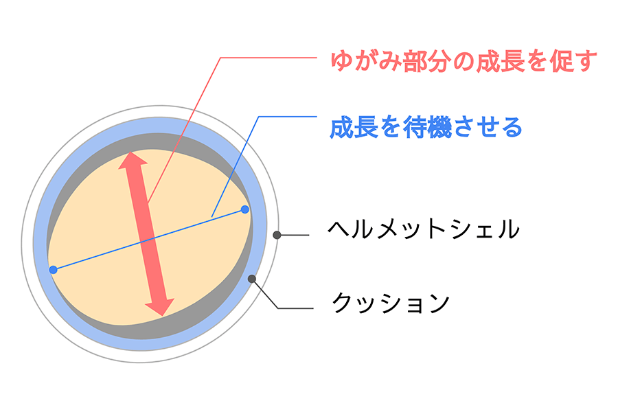 ヘルメット治療の原理について