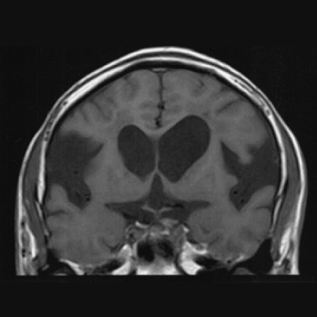 MRI冠状断　脳室