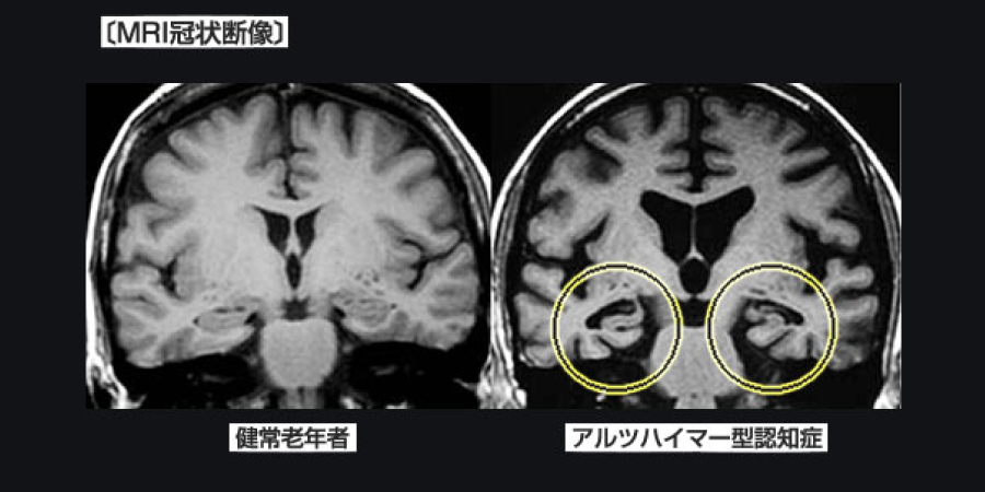 MRI冠状断像