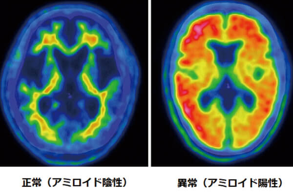アルツハイマー型認知症の検査
