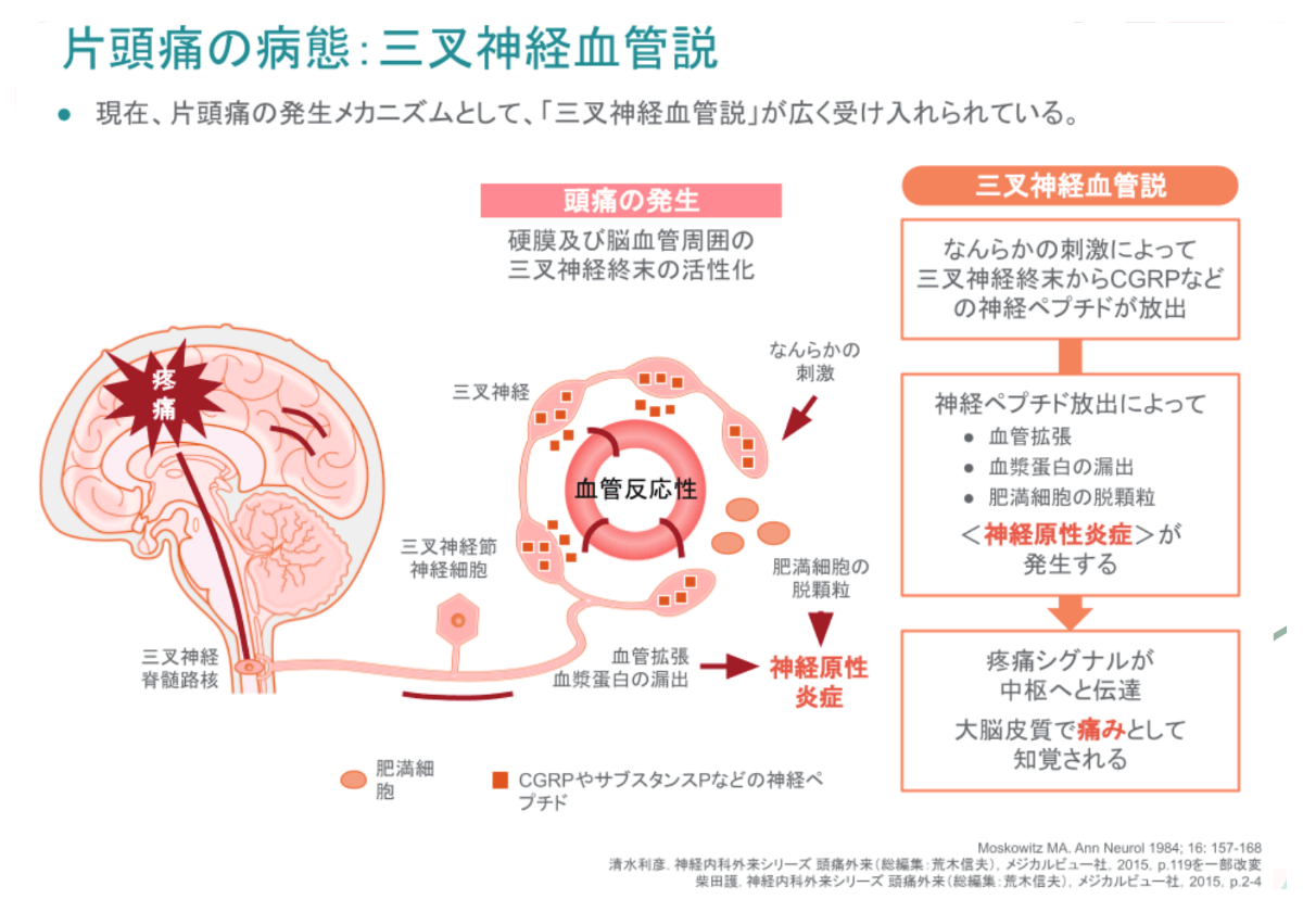 片頭痛のメカニズム